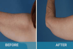 arm-lift-before-and-after-gold-coast